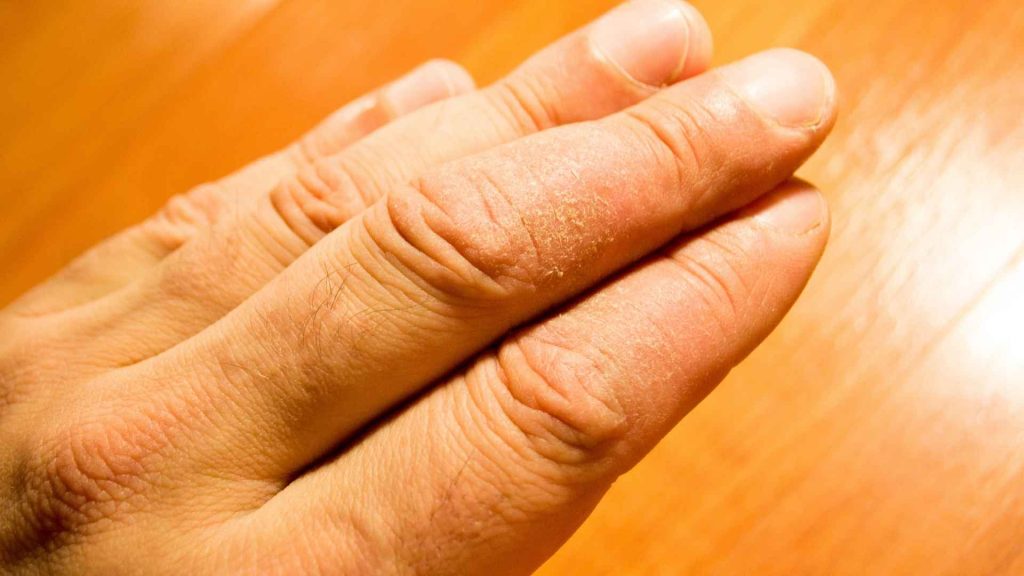 פסוריאזיס בציפורניים