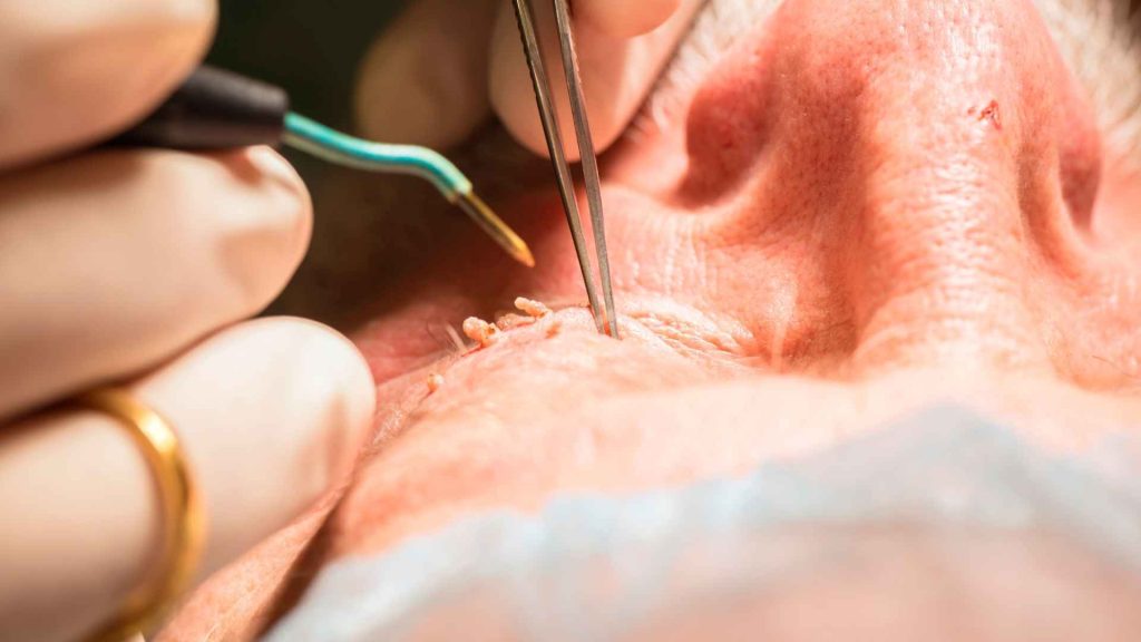 טיפולי אסתטיקה להסרת נגעי עור