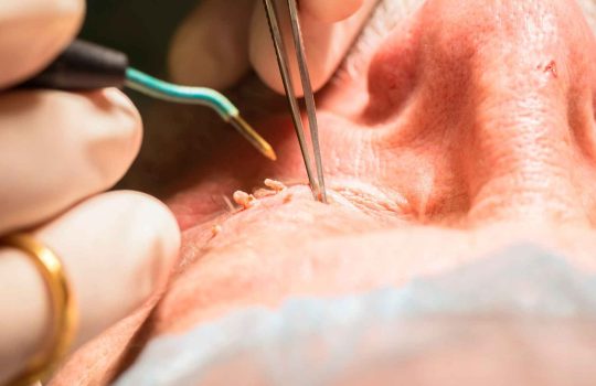 טיפולי אסתטיקה להסרת נגעי עור2