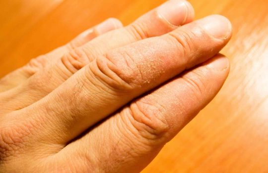 פסוריאזיס בציפורניים2